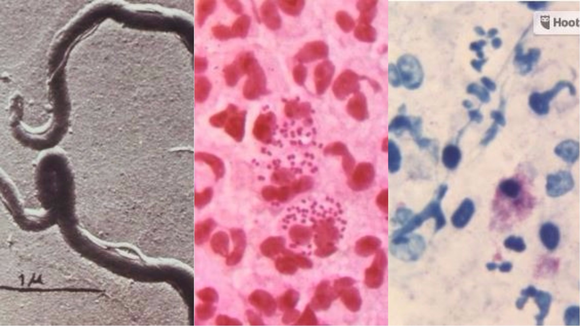 Syphilis, chlamydia, and gonorrhea on the rise in King County